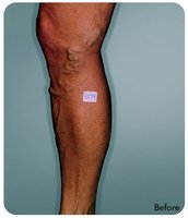 Varicose veins in the leg