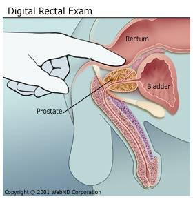 Digital rectal exam for prostate gland