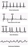 ECG examples of dysrhythmias