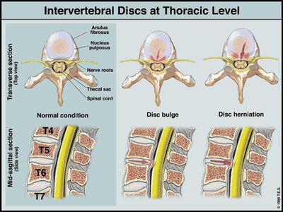 Diagram showing normal, bulging, and herniated intervertebral discs