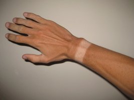 Tan lines showing effect of UV exposure on skin color