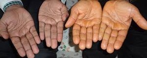 Carotene accumulation in palms