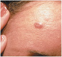 Basal cell carcinoma on the skin