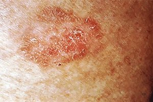 Squamous cell carcinoma on the skin