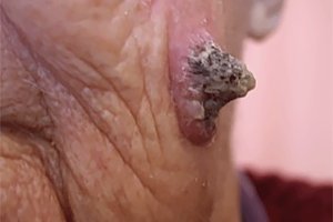 Advanced squamous cell carcinoma