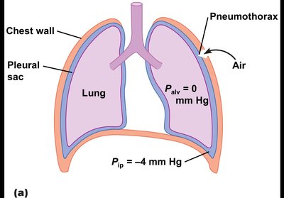 Pneumothorax diagram