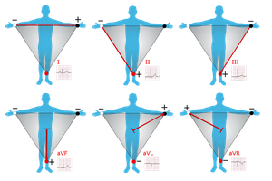 Diagram showing the six limb leads and their directions on the body