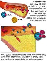 Cholesterol and plaque formation in arteries