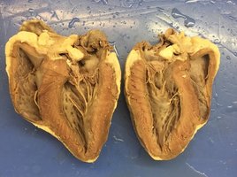Diagram showing blood flow through the heart chambers and valves