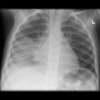 Pneumonia X-ray