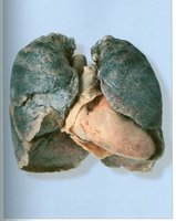 Effects of smoking on the lungs