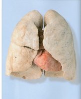 Healthy vs. smoker's lungs