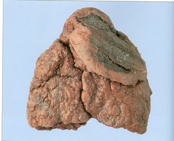 Lung cancer appearance