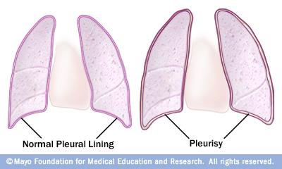 Normal pleural lining vs pleurisy