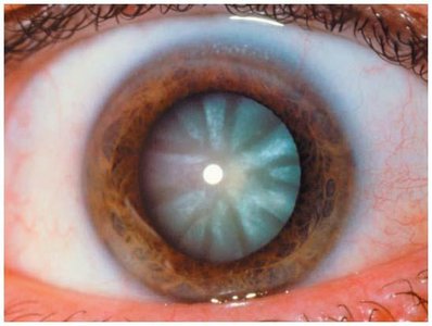 Photograph of a cataract