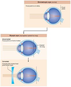 Diagram comparing emmetropic, hyperopic, and corrected hyperopic eyes