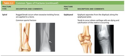 Common types of fractures: spiral and epiphyseal