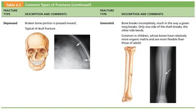 Common types of fractures: depressed and greenstick