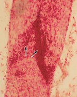 Valve in a lymphatic vessel