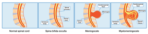 Spina bifida diagram