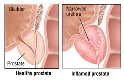 Diagram comparing healthy and inflamed prostate