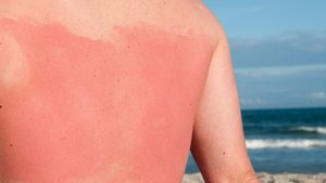 First-degree burn (sunburn)