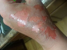 Second-degree burn with blisters
