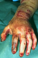Third-degree burn with full-thickness damage