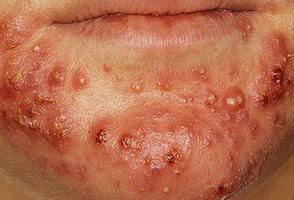 Clinical image of sebaceous gland dysfunction (acne)