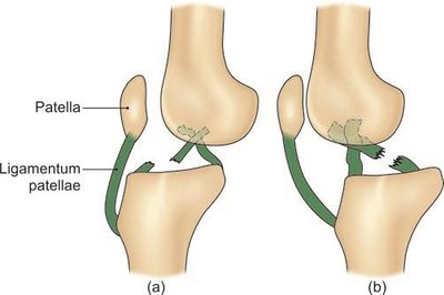 Rupture of anterior and posterior cruciate ligaments