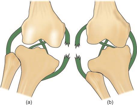 Rupture of medial and lateral collateral ligaments