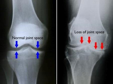 X-ray showing normal and osteoarthritic knee joint space