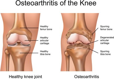 Osteoarthritis of the knee joint