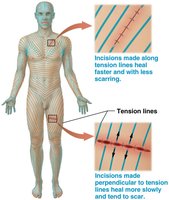 Tension lines in the skin