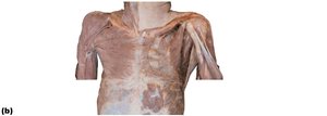 Cadaver dissection of anterior thorax muscles