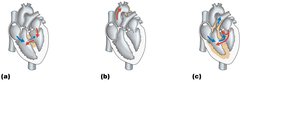 Examples of congenital heart defects
