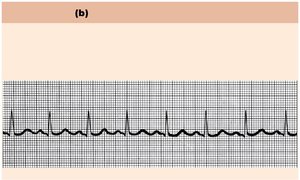 Normal and abnormal ECG tracings