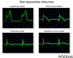 Post myocardial infarction ECG phases
