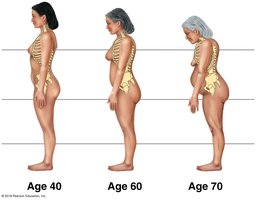 Progression of kyphosis with age in women