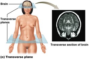 Transverse plane and transverse section of brain
