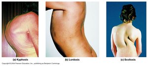 Variations of spinal alignment: kyphosis, lordosis, scoliosis