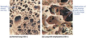 Tissue changes in emphysema