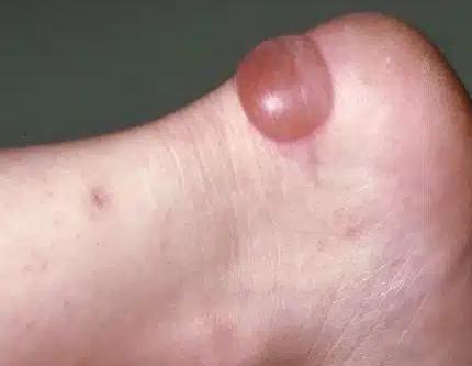 Epidermal ridges and fingerprints