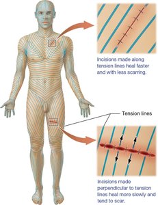 Flexure lines at the elbow