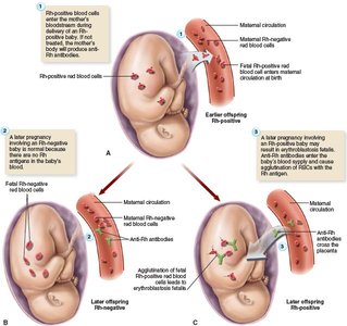 Erythroblastosis fetalis: Rh incompatibility in pregnancy