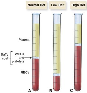 Hematocrit test tubes showing normal, low, and high Hct