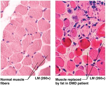 Normal muscle fibers vs. muscle replaced by fat in DMD patient