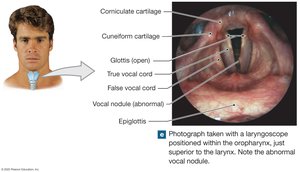 Laryngoscopic view of vocal cords