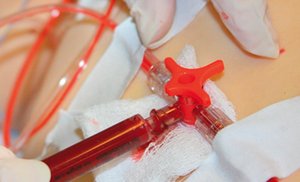 ABG sampling procedure