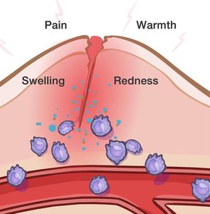 Inflammatory response: redness, heat, swelling, pain